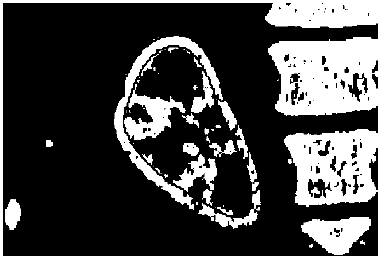 A Localization Method of Renal Cortex Based on Statistical Shape Model