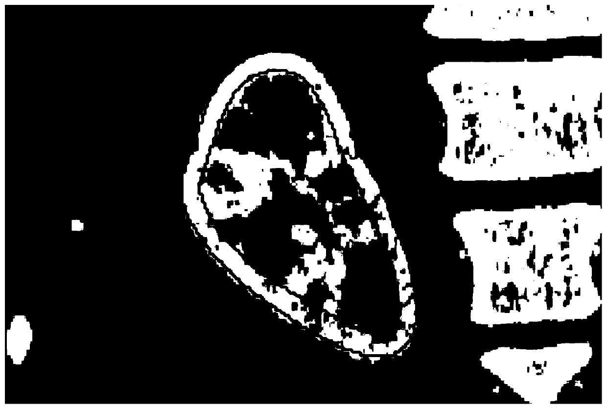 A Localization Method of Renal Cortex Based on Statistical Shape Model