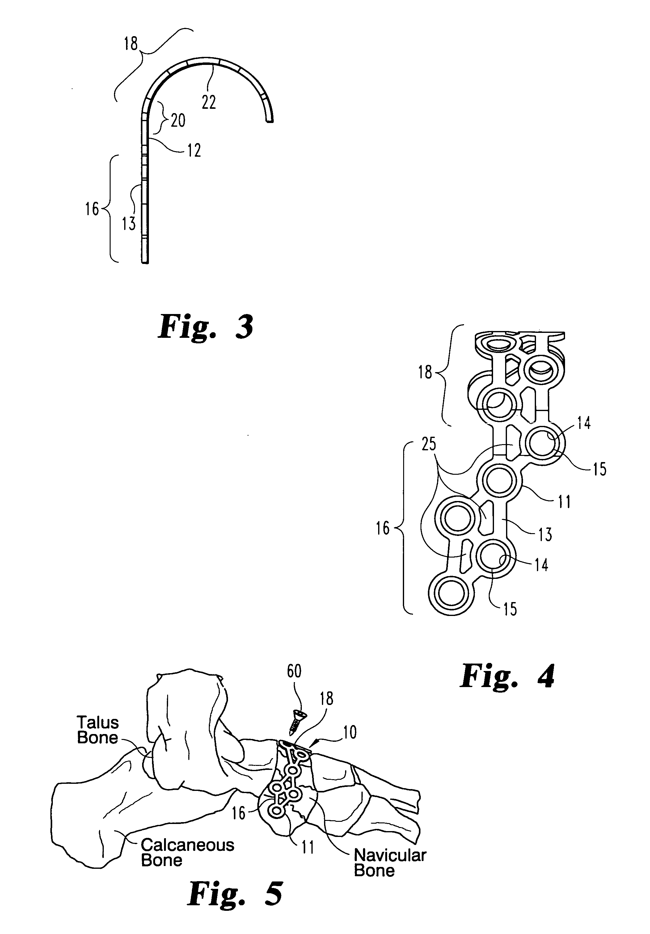 Navicular fixation device