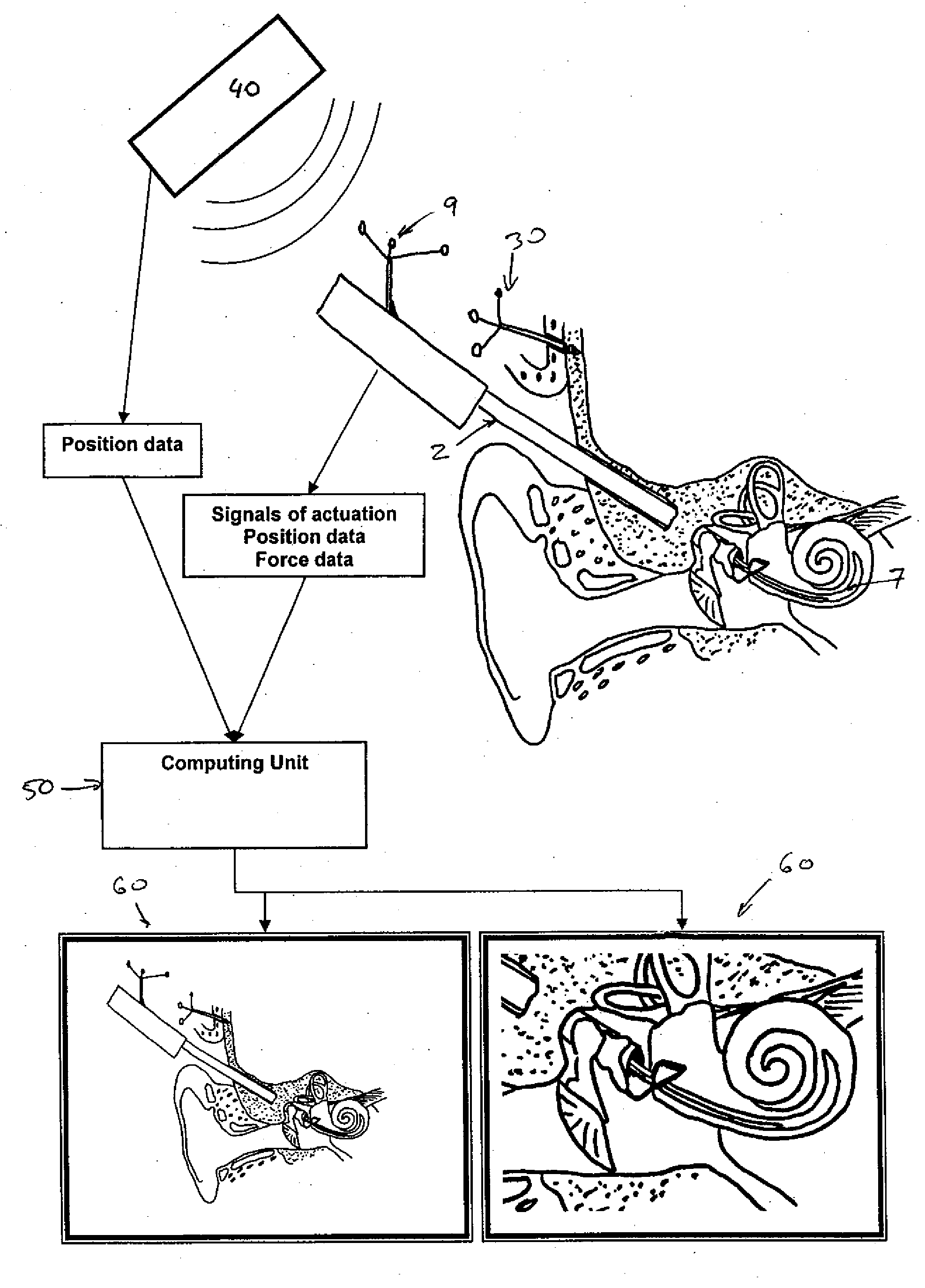 Apparatus and system for insertion of an implant