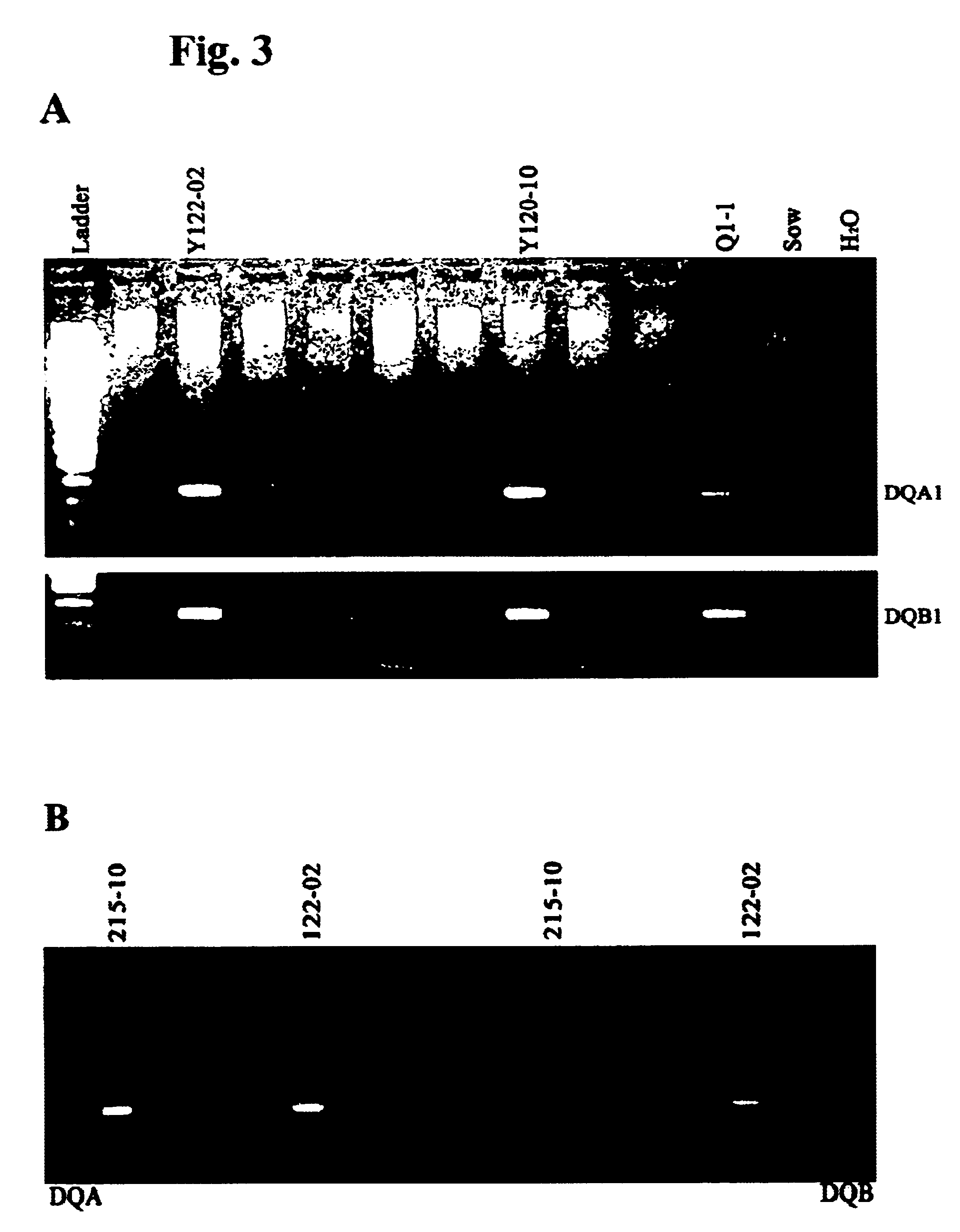 Transgenic swine having HLA-D gene, swine cells thereof and xenografts therefrom