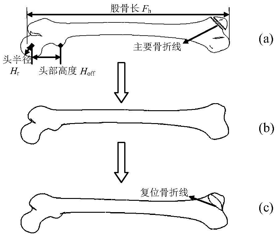 Design method of personalized distal anatomical bone plate based on patient's femoral parameters