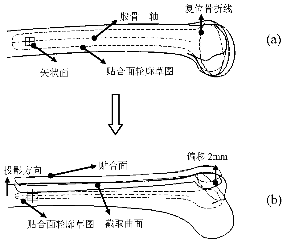 Design method of personalized distal anatomical bone plate based on patient's femoral parameters