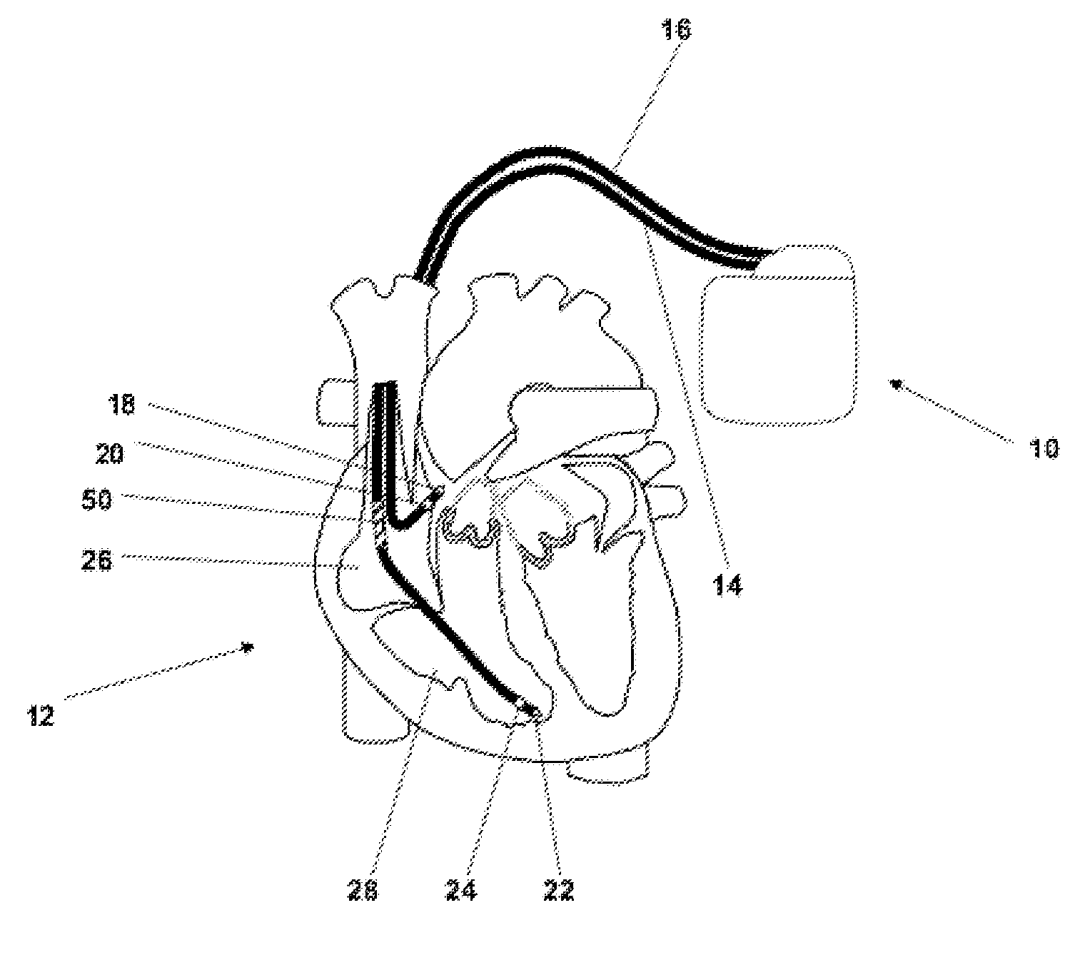 Implantable medical device