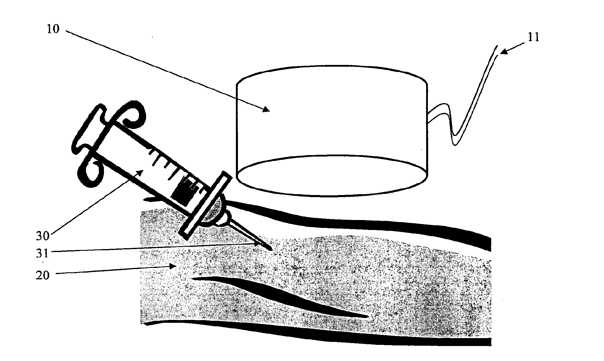 Apparatus and method for non-invasively locating blood vessels