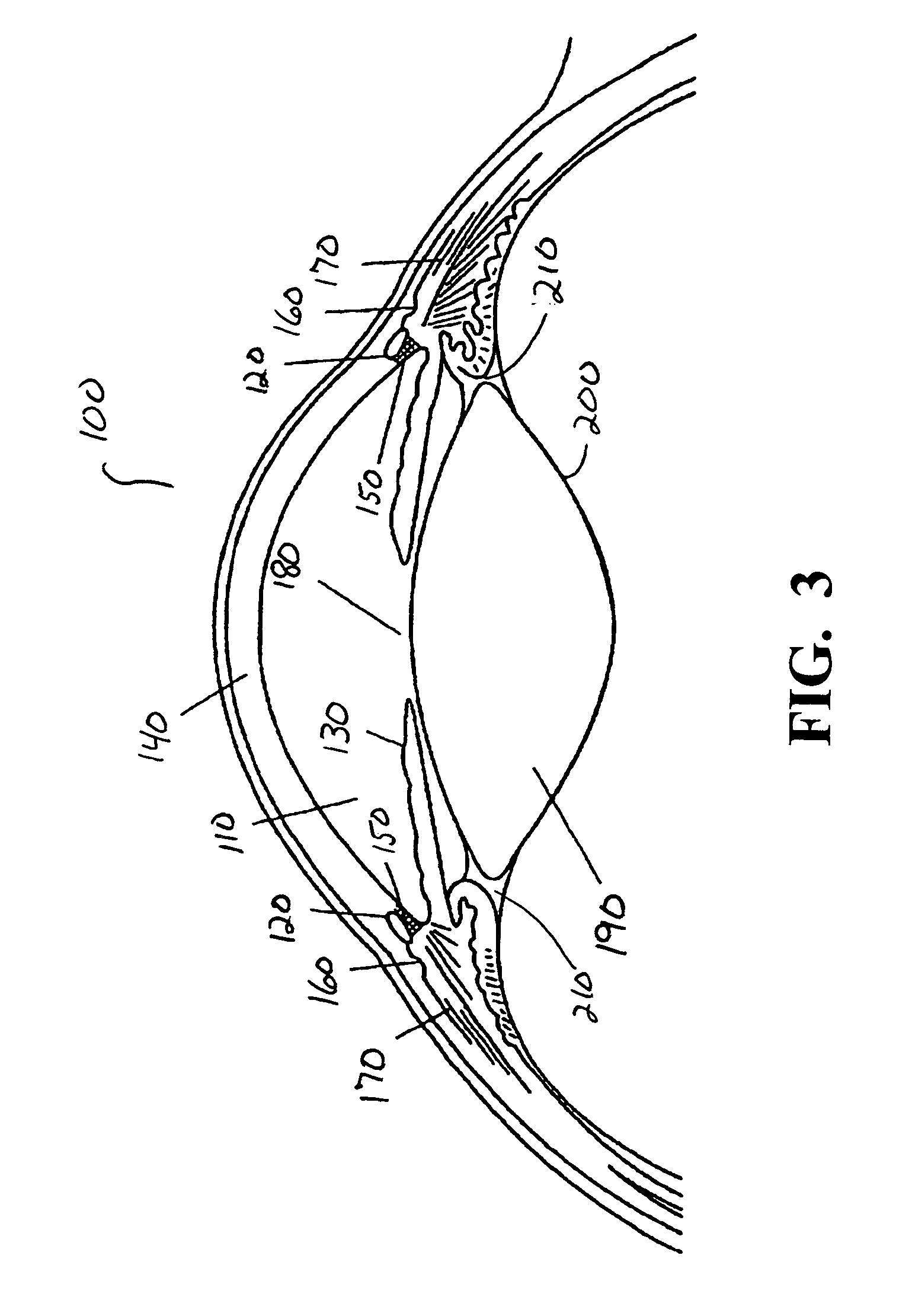 Surgical method