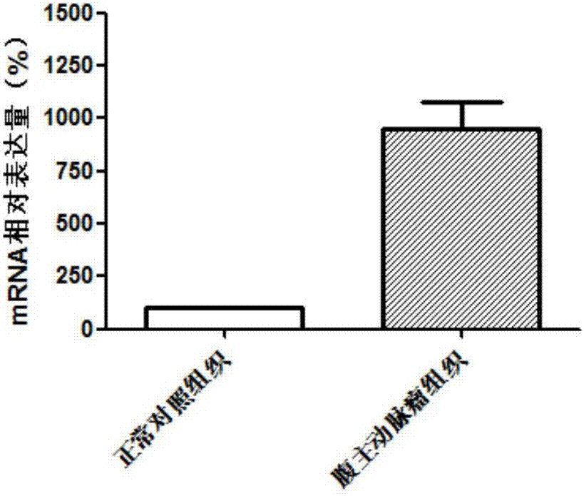 Biomarker for diagnosis and treatment of abdominal aortic aneurysms