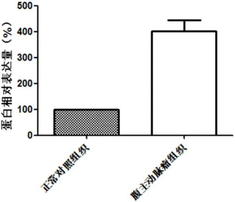 Biomarker for diagnosis and treatment of abdominal aortic aneurysms