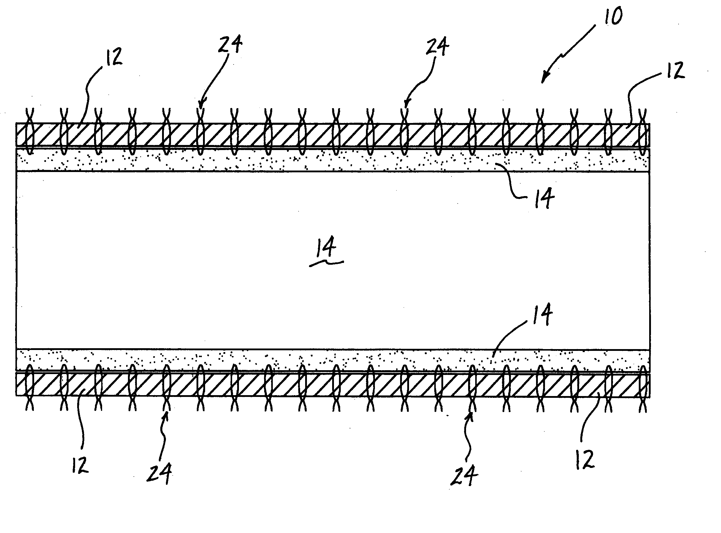 Systems and methods for overcoming or preventing vascular flow restrictions