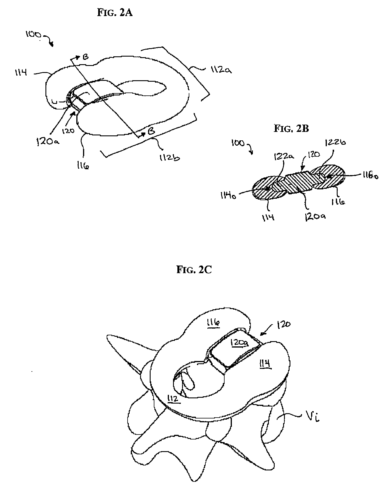 C-Shaped Disc Prosthesis