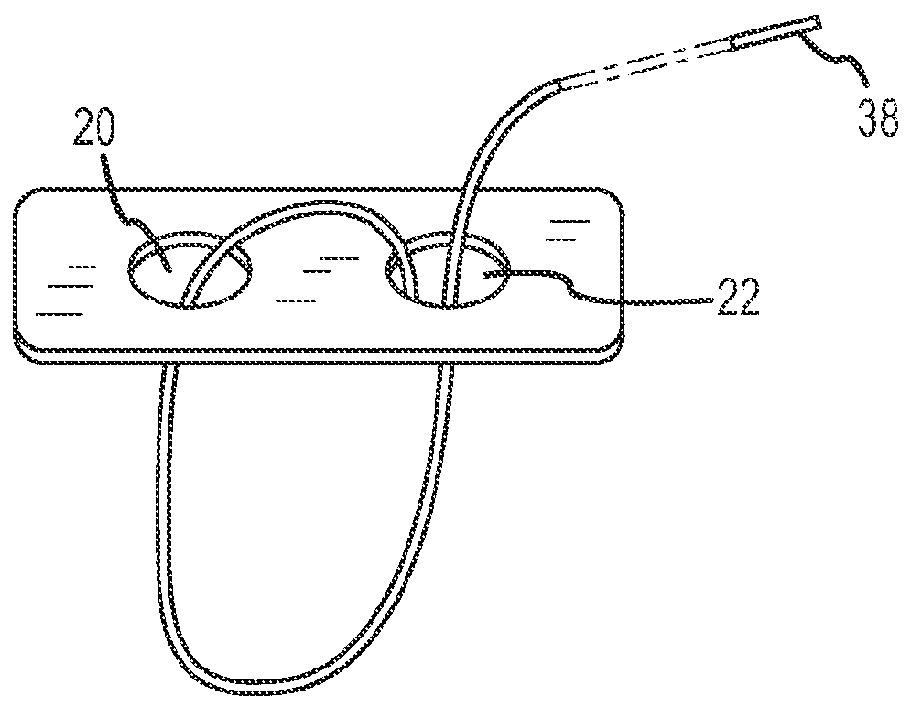 Suspensory graft fixation with adjustable loop length