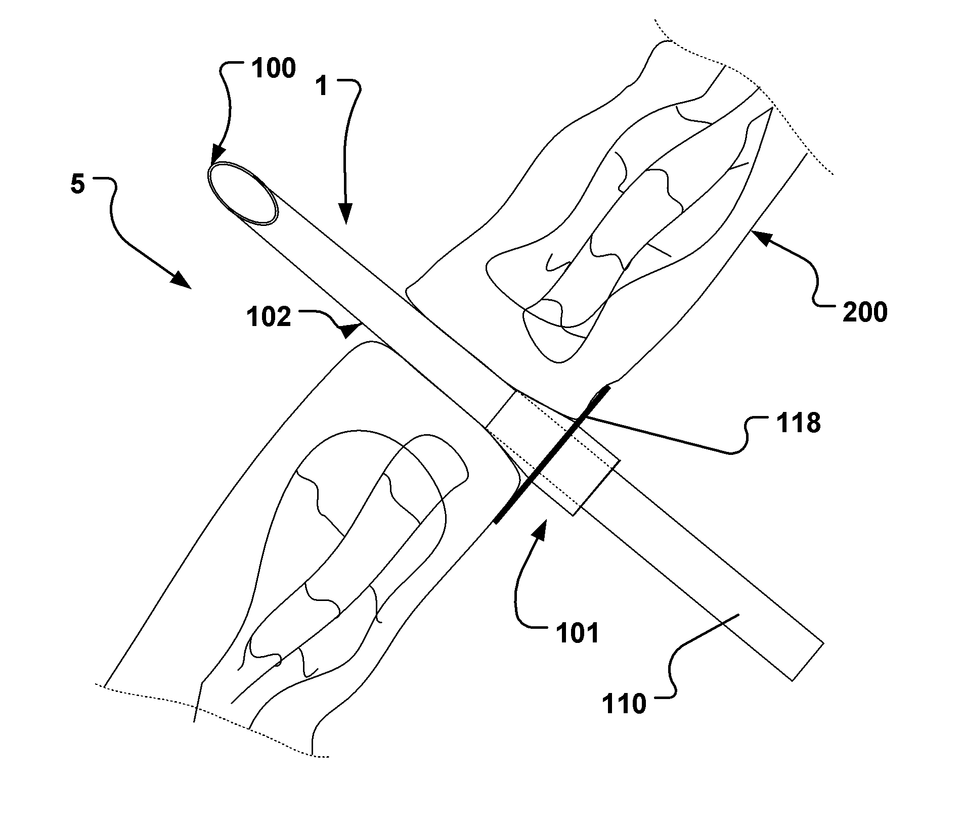 Endoluminal medical access device