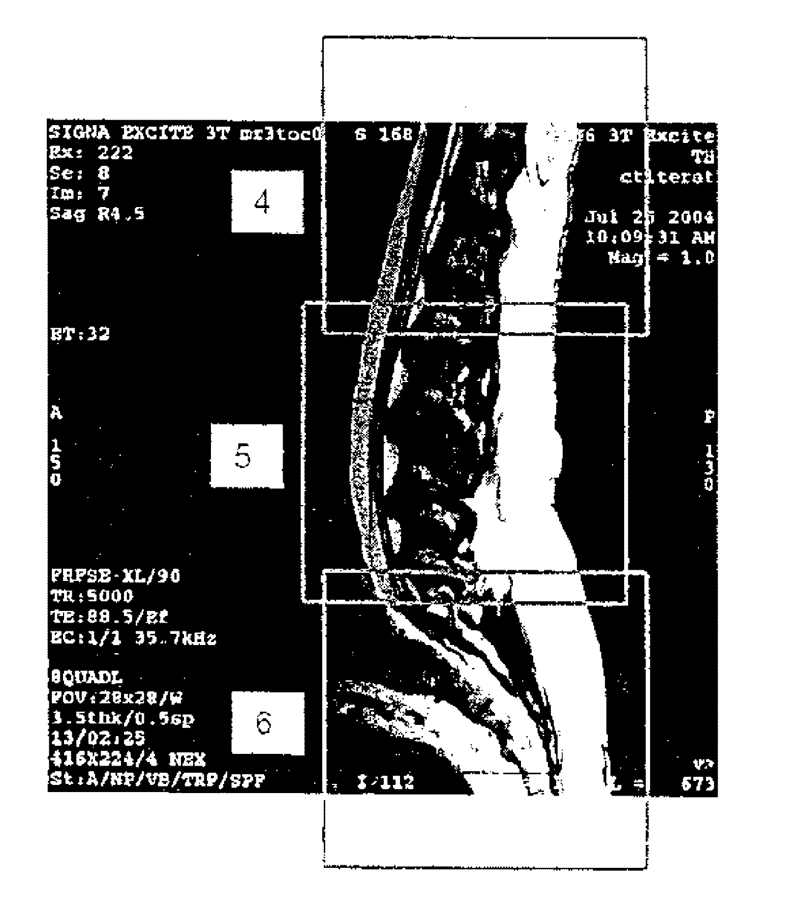 Mr spectroscopy system and method for diagnosing painful and non-painful intervertebral discs