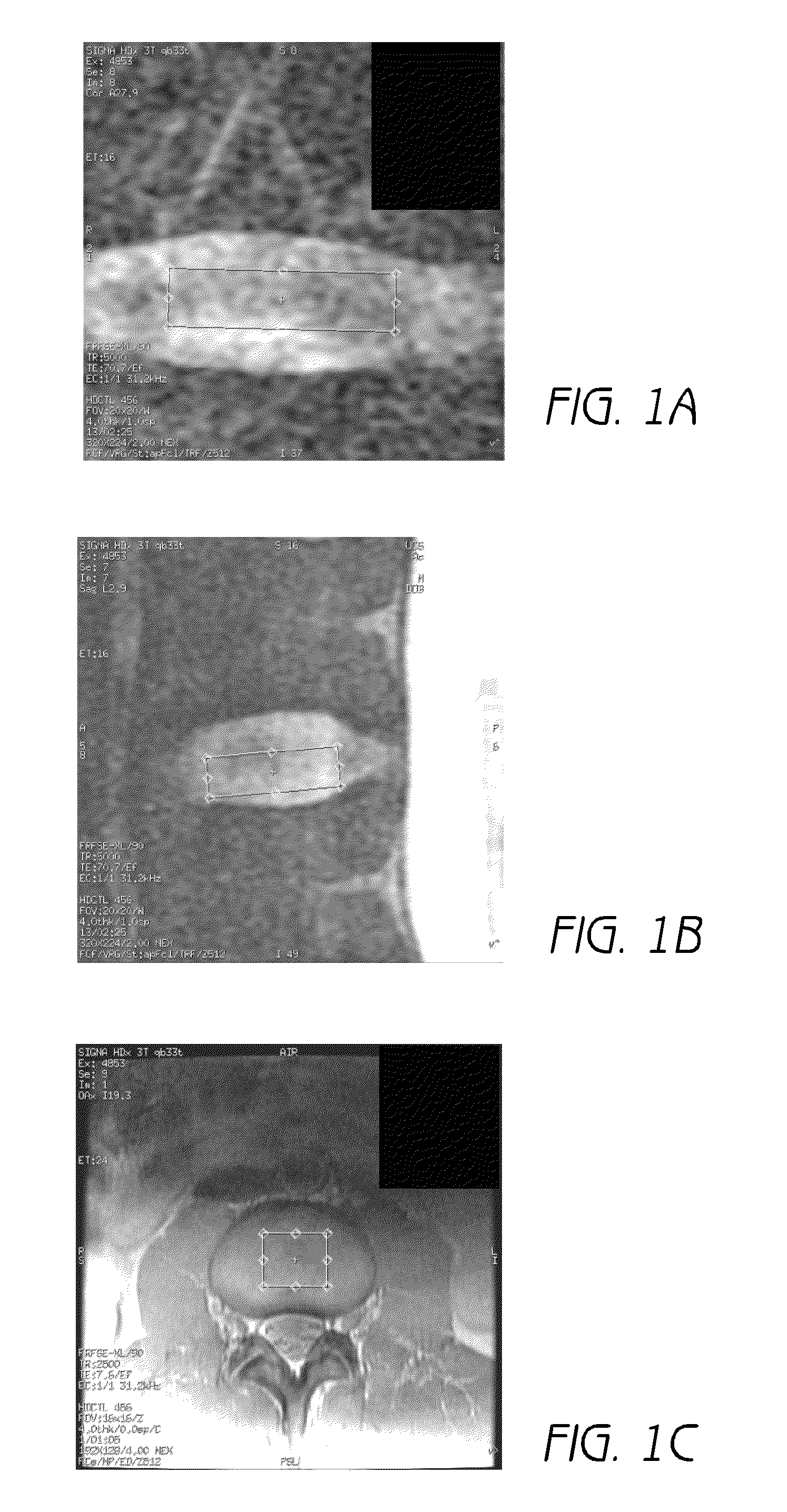 Mr spectroscopy system and method for diagnosing painful and non-painful intervertebral discs