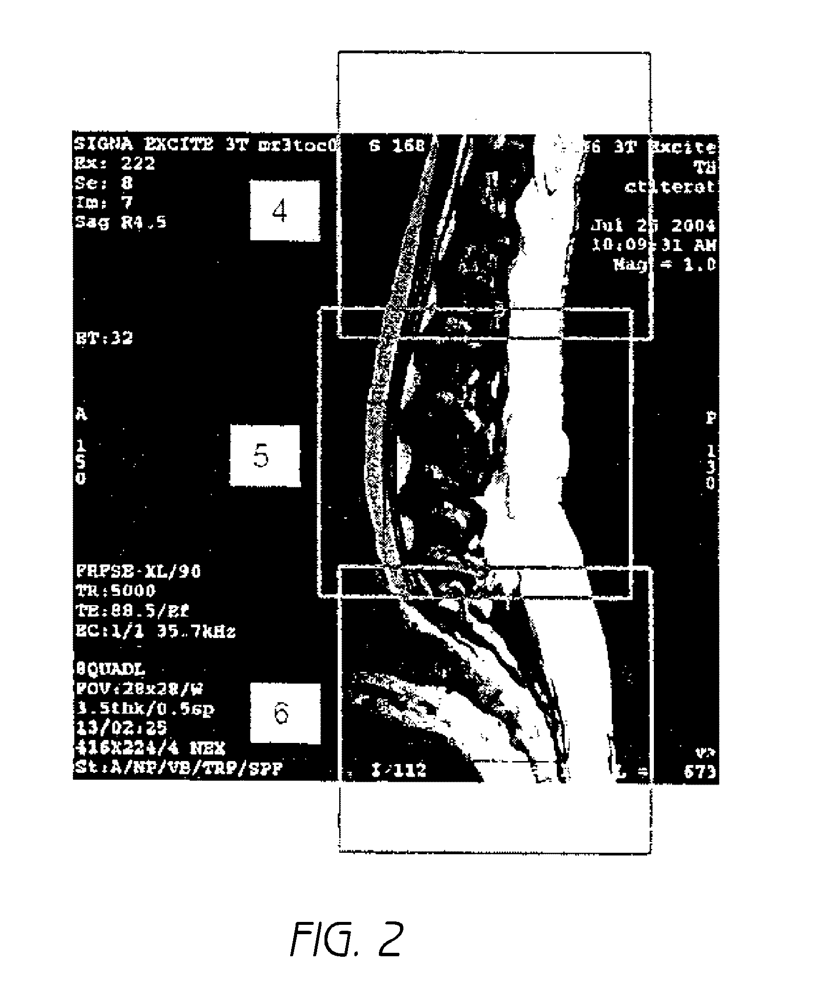 Mr spectroscopy system and method for diagnosing painful and non-painful intervertebral discs