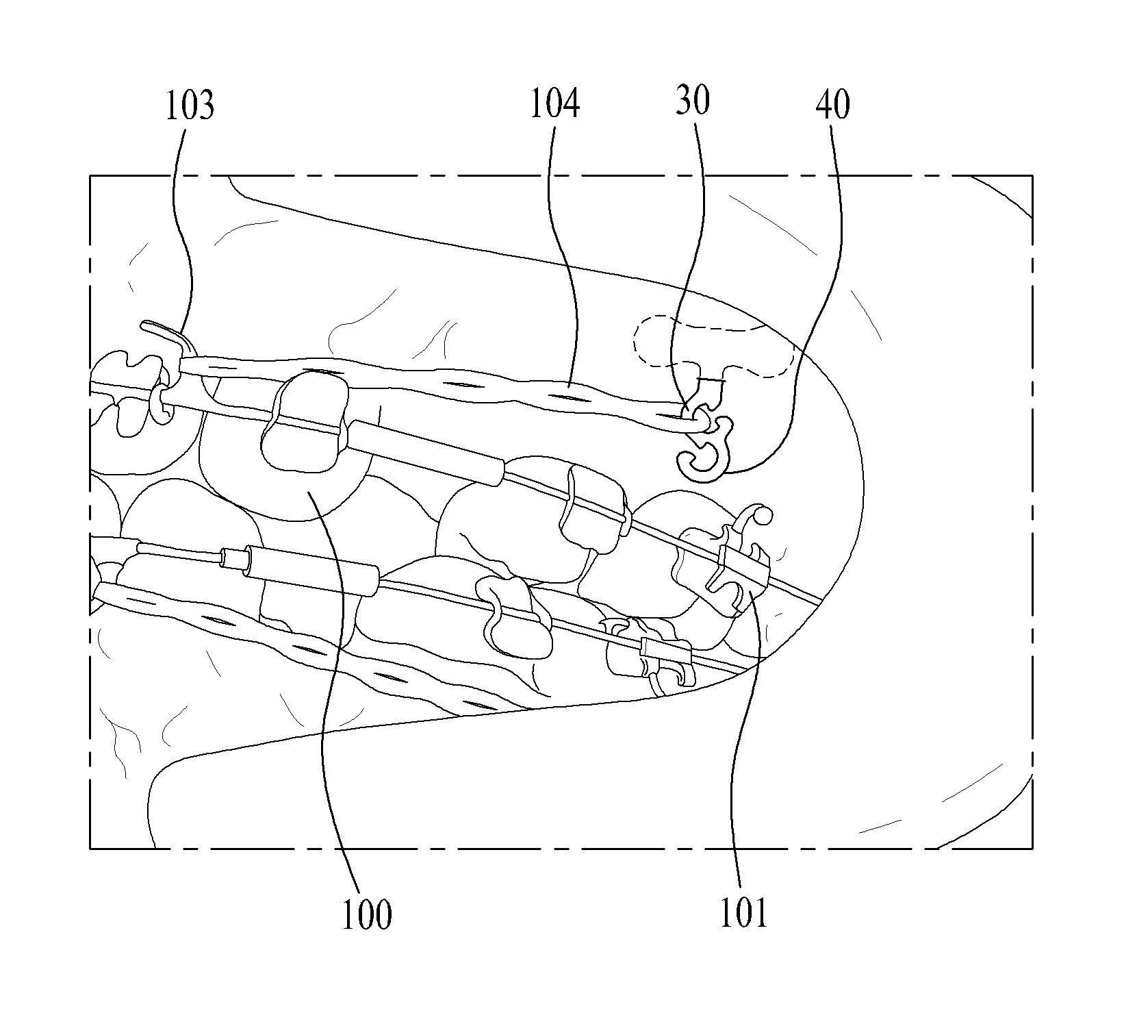 Buccal fixture for orthodontic use