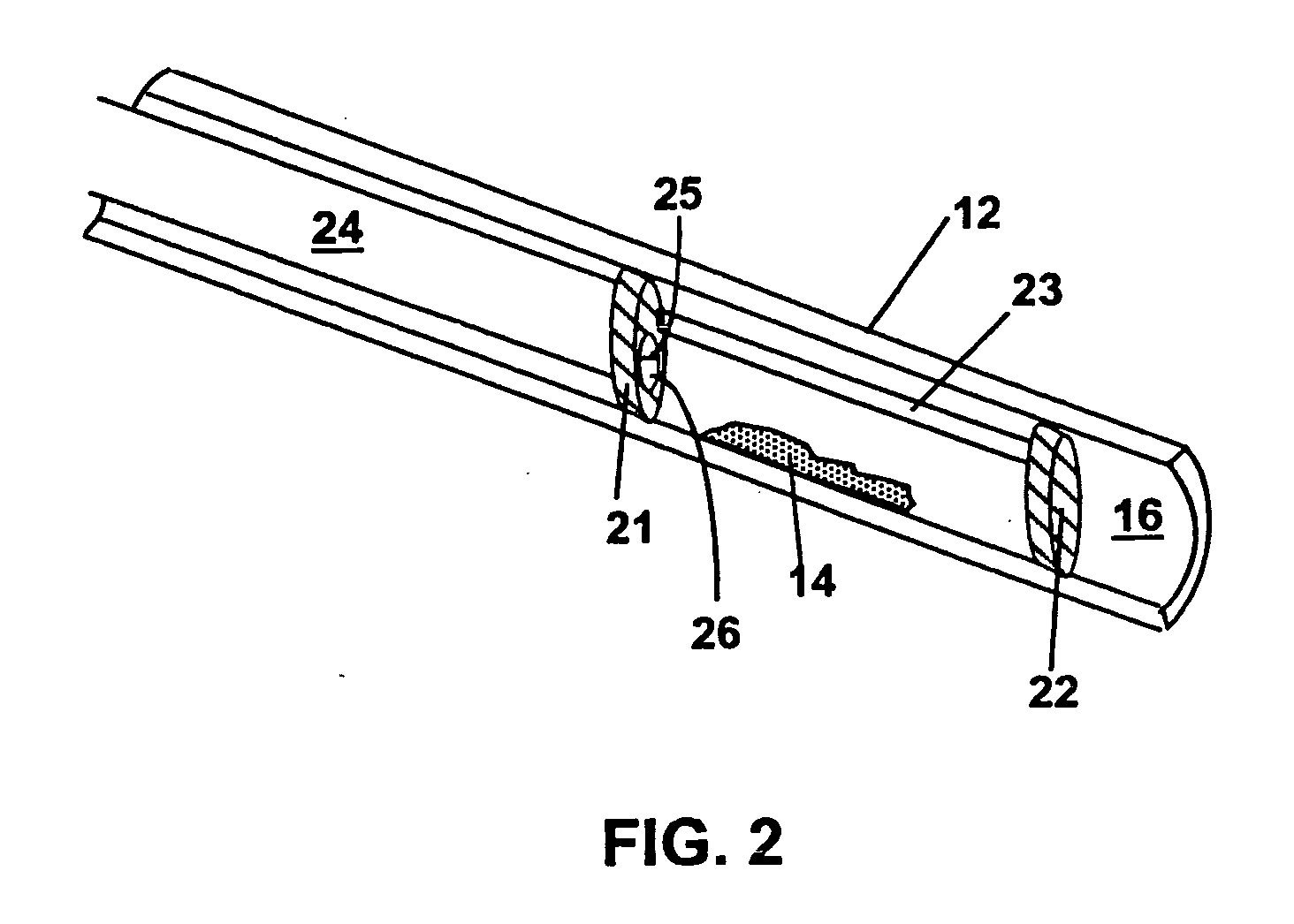 Methods and devices for reducing the mineral content of vascular calcified lesions