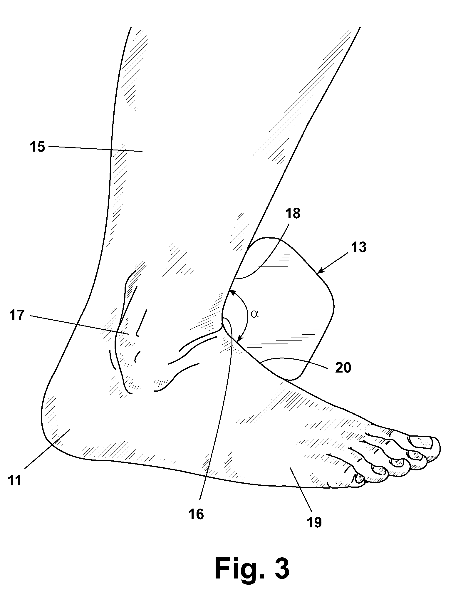 Correcting foot alignment