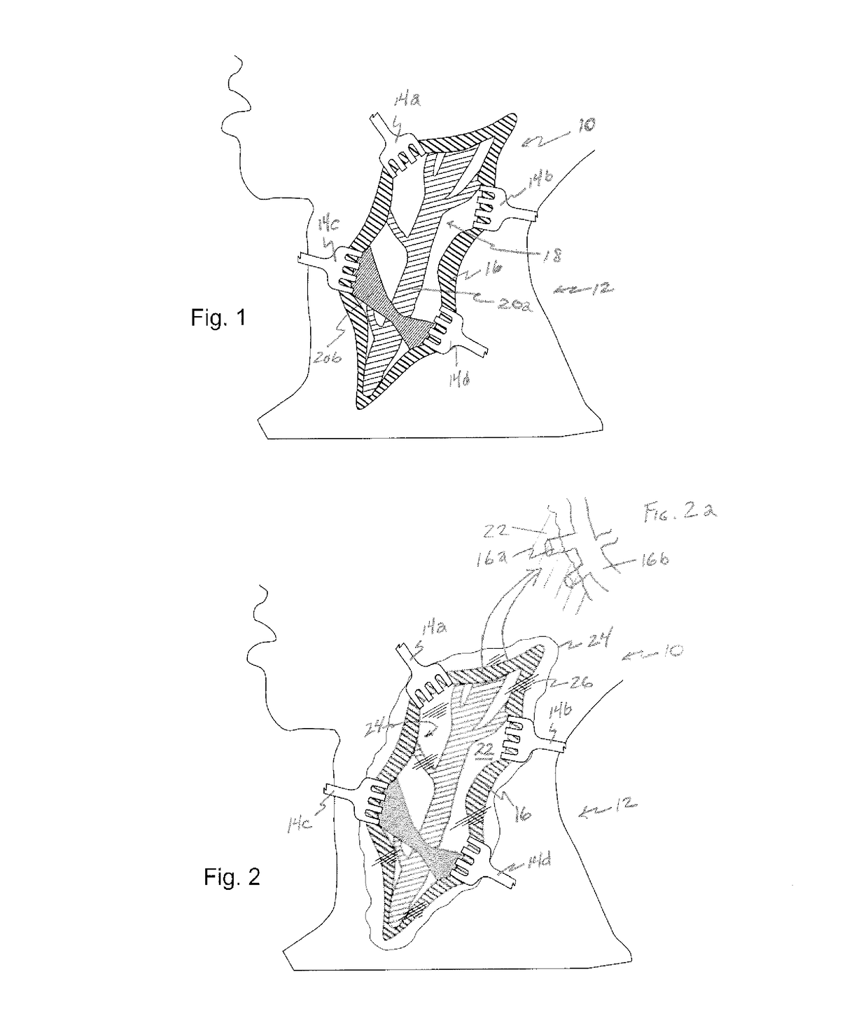 Expandable medical device and method of use