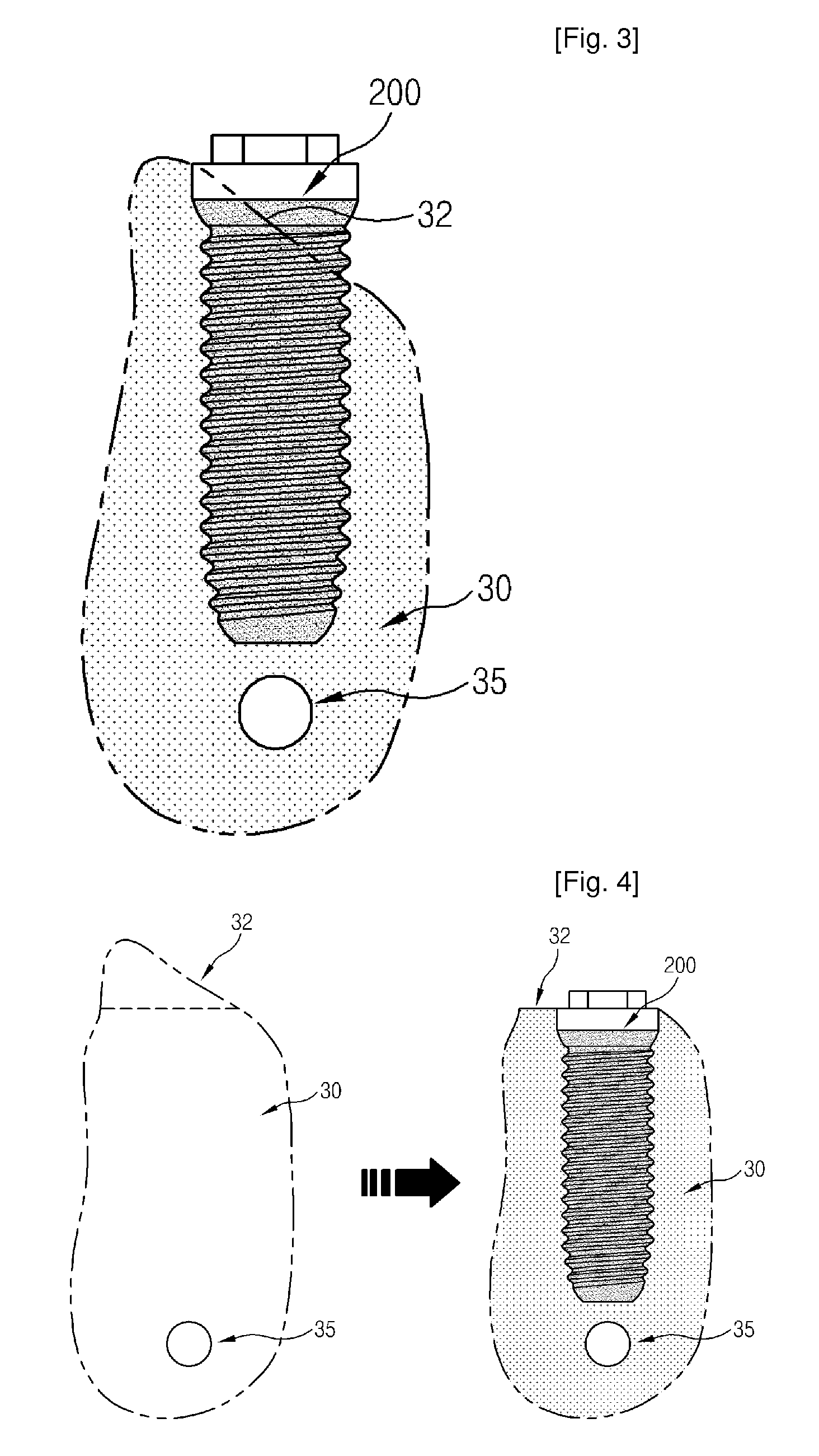 Dental Implant Fixture