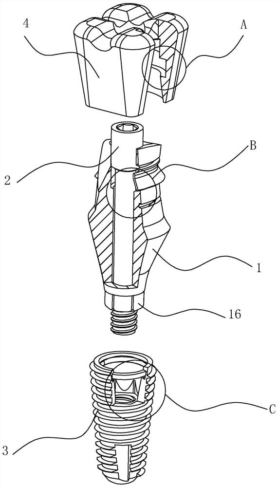 Personalized transfer composite abutment