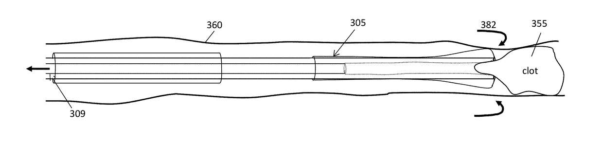 Pre-loaded inverting tractor thrombectomy apparatuses and methods