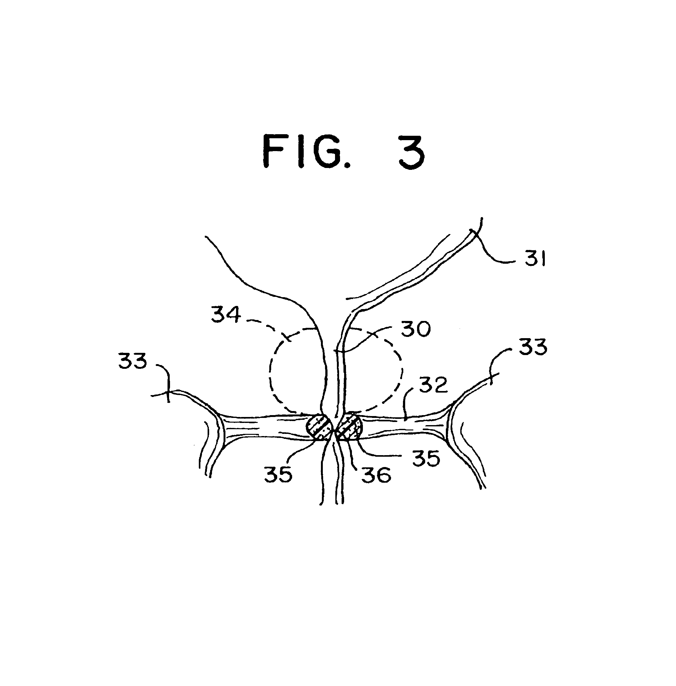 Soft tissue substitute and method of soft tissue reformation