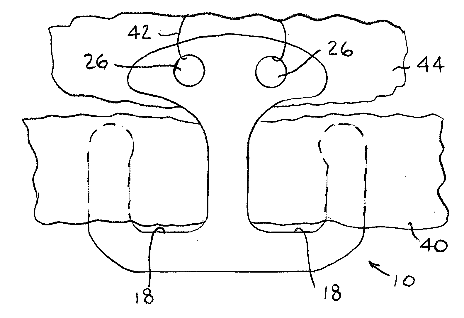 Intraocular clip