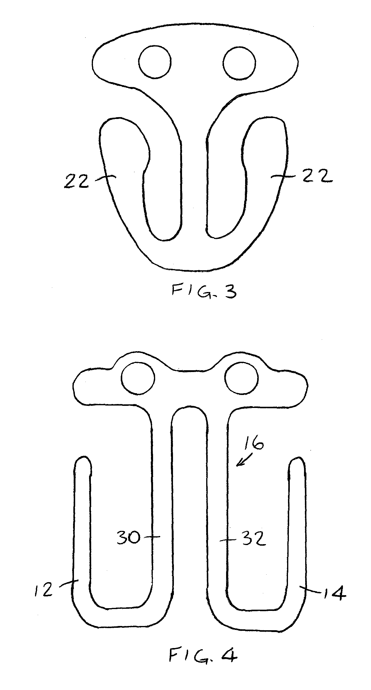 Intraocular clip