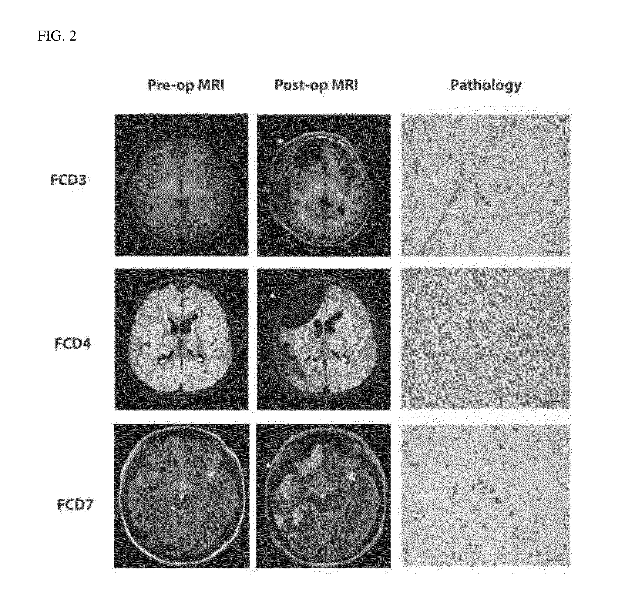 Brain somatic mutations associated to epilepsy and uses thereof