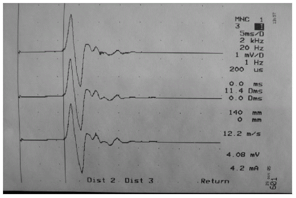 A compound preparation used for treating diabetic painful sensory neuropathy and applications thereof