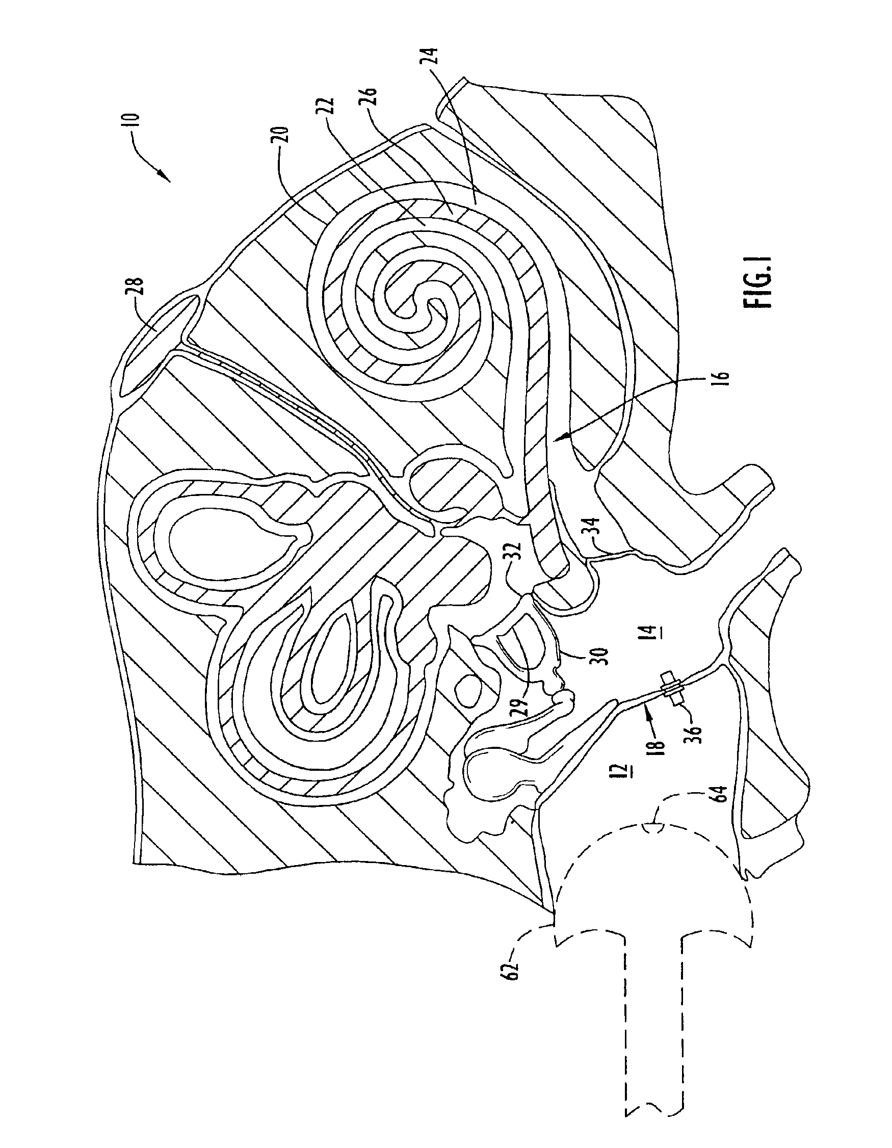 Apparatus and method for displacing the partition between the middle ear and the inner ear using a manually powered device