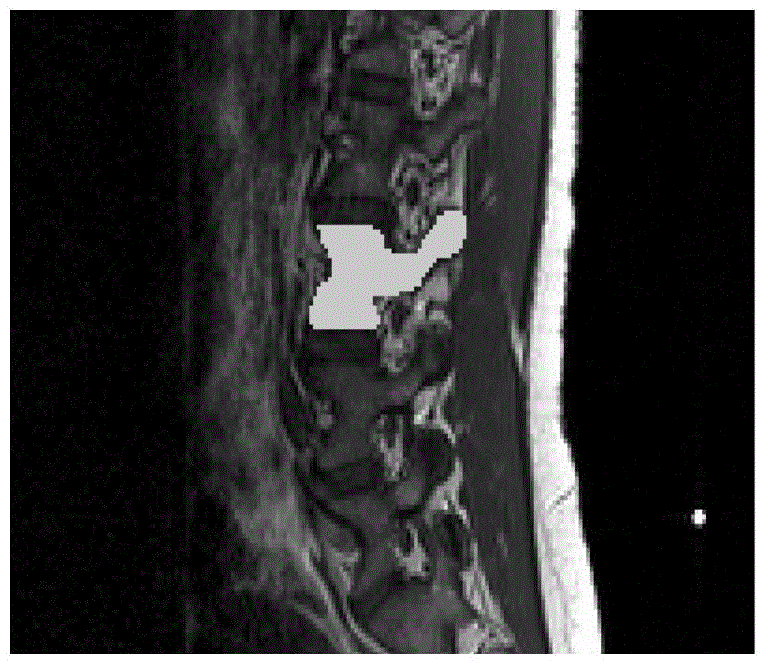 Harris-based spine feature point automatic recognizing method