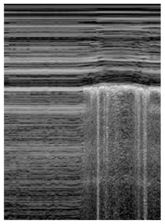 Automatic pneumothorax detection system based on B-mode ultrasound