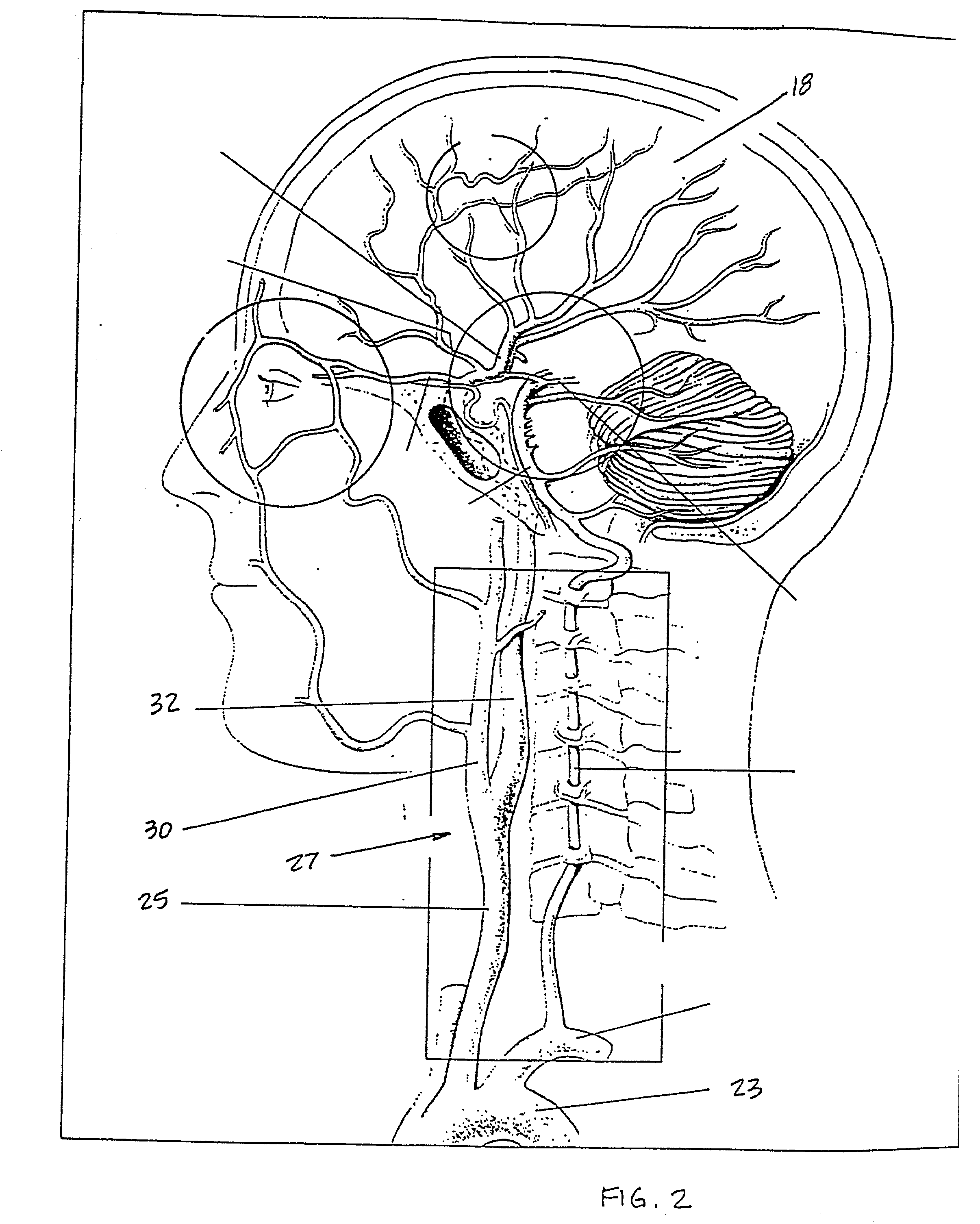 Indwelling heat exchange catheter and method of using same