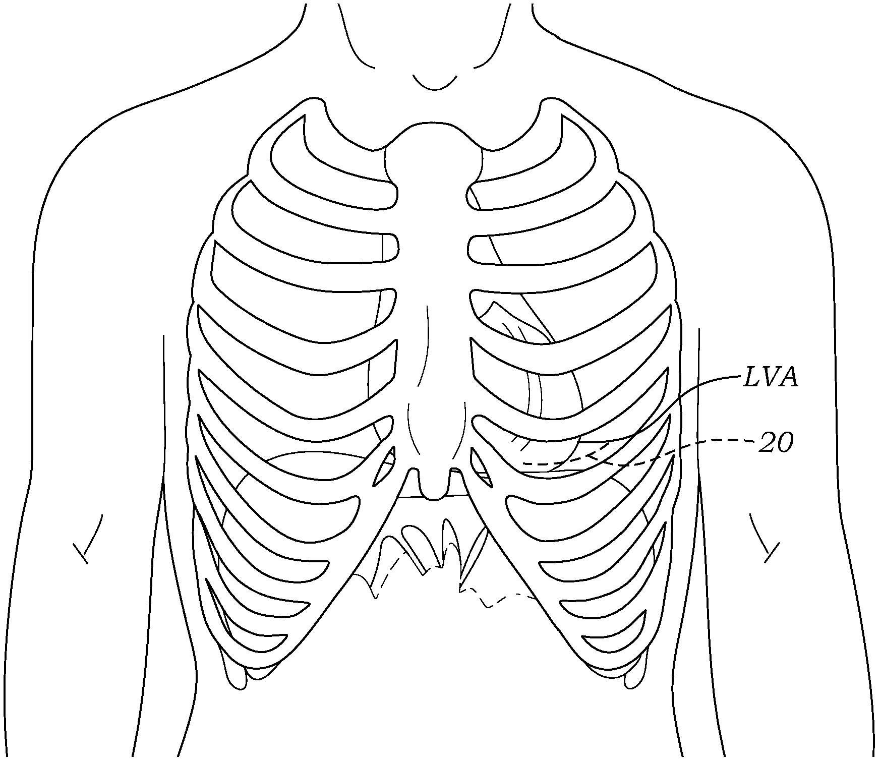 Transapical deliverry system for heart valves