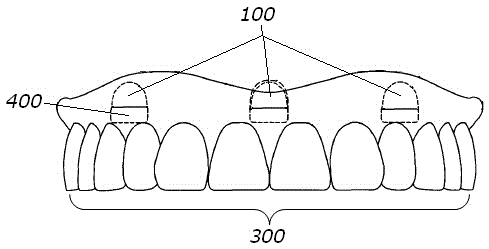 Implant prosthesis for restoration of partial or whole tooth loss and manufacturing method of implant prosthesis