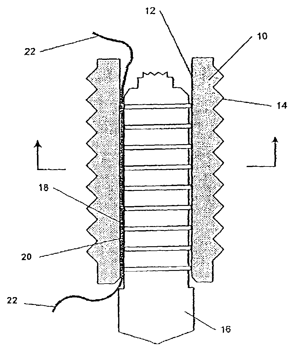 Self-locking suture anchor