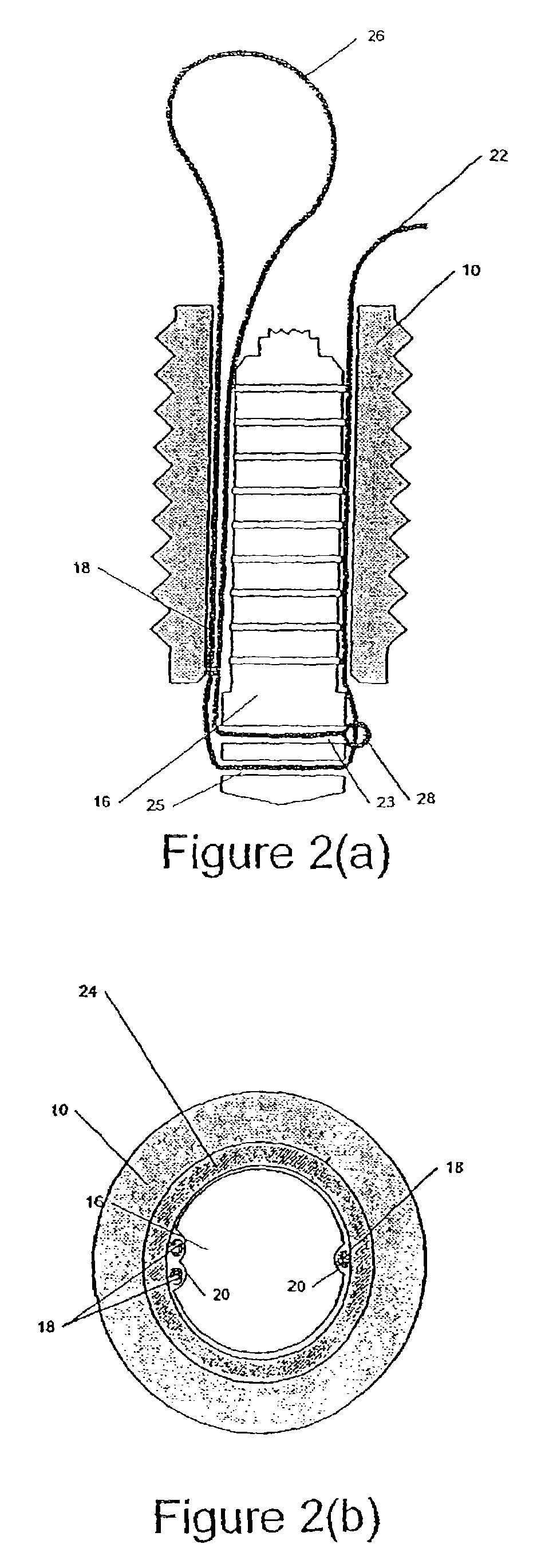 Self-locking suture anchor