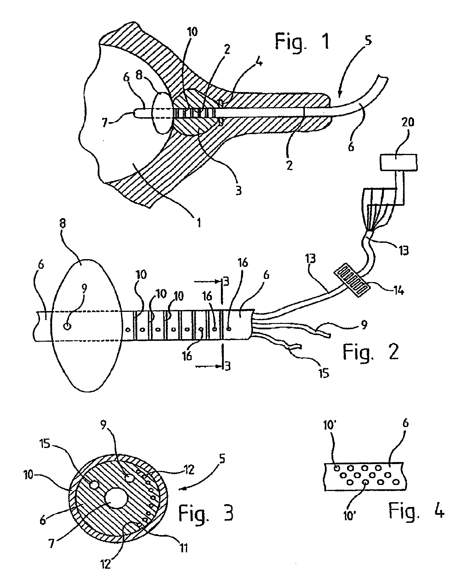 Urological balloon catheter