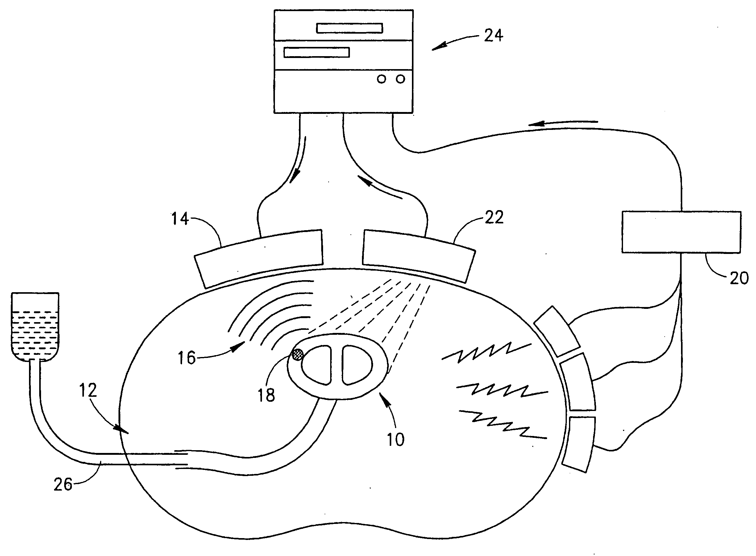 Ultrasound cardiac stimulator