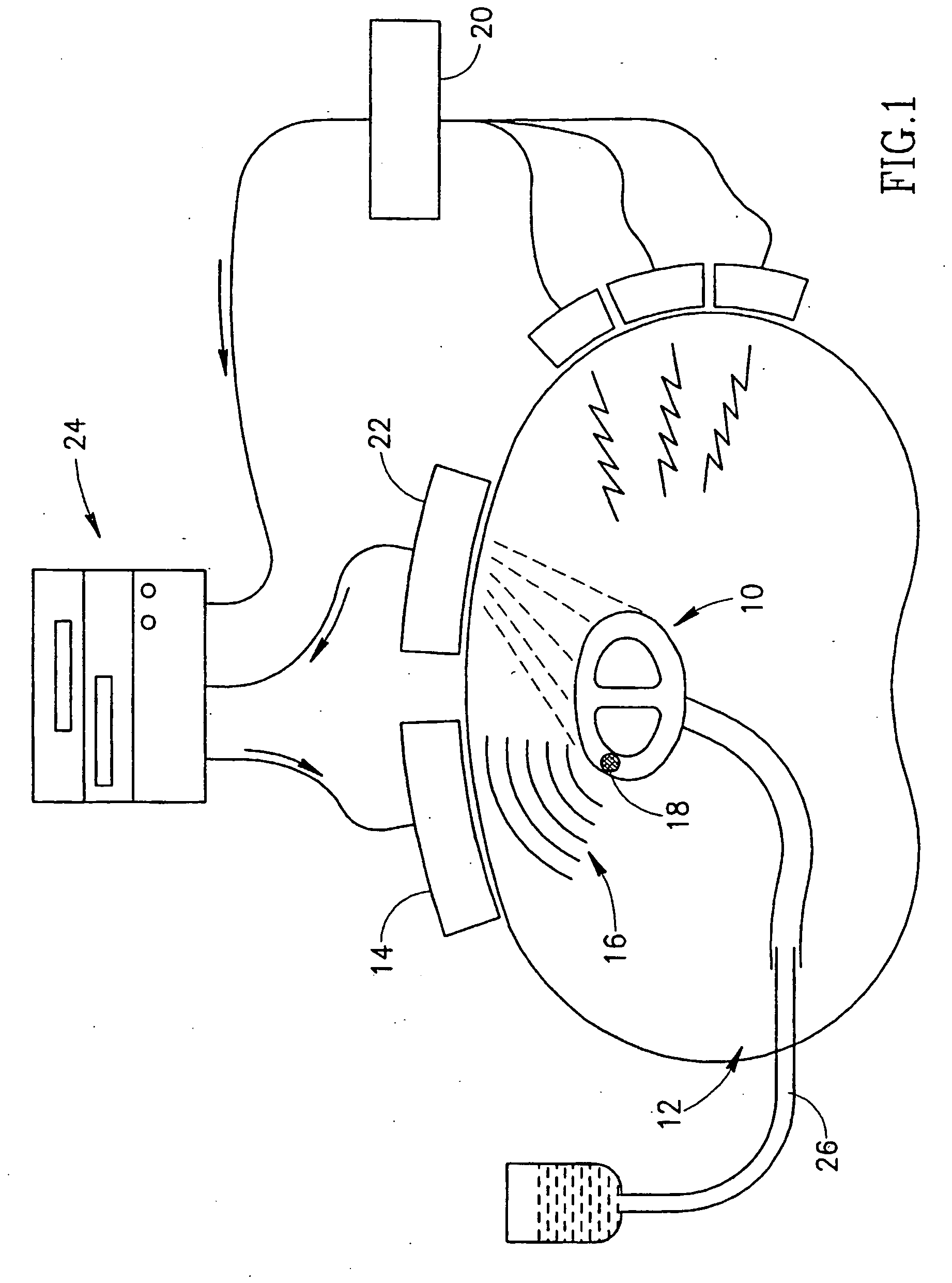 Ultrasound cardiac stimulator