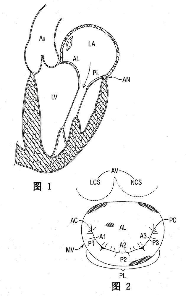 Degenerative valvular disease specific annuloplasty rings