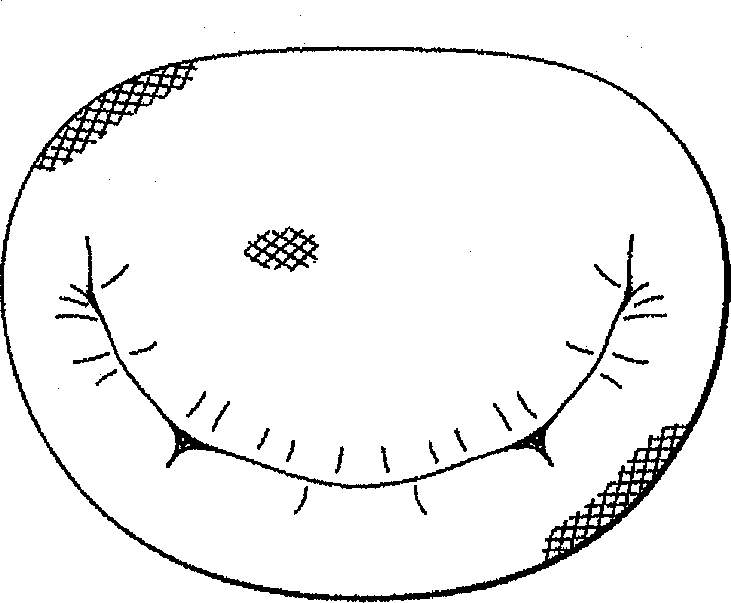 Degenerative valvular disease specific annuloplasty rings