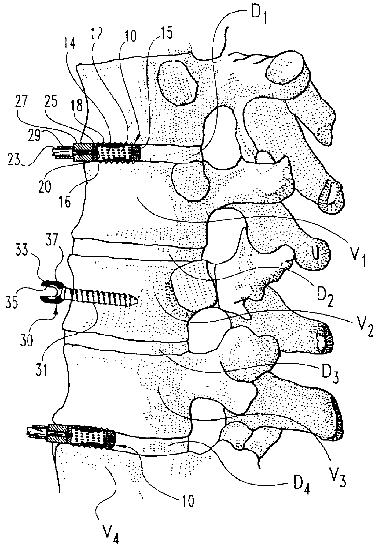 Anterior spinal instrumentation and method for implantation and revision