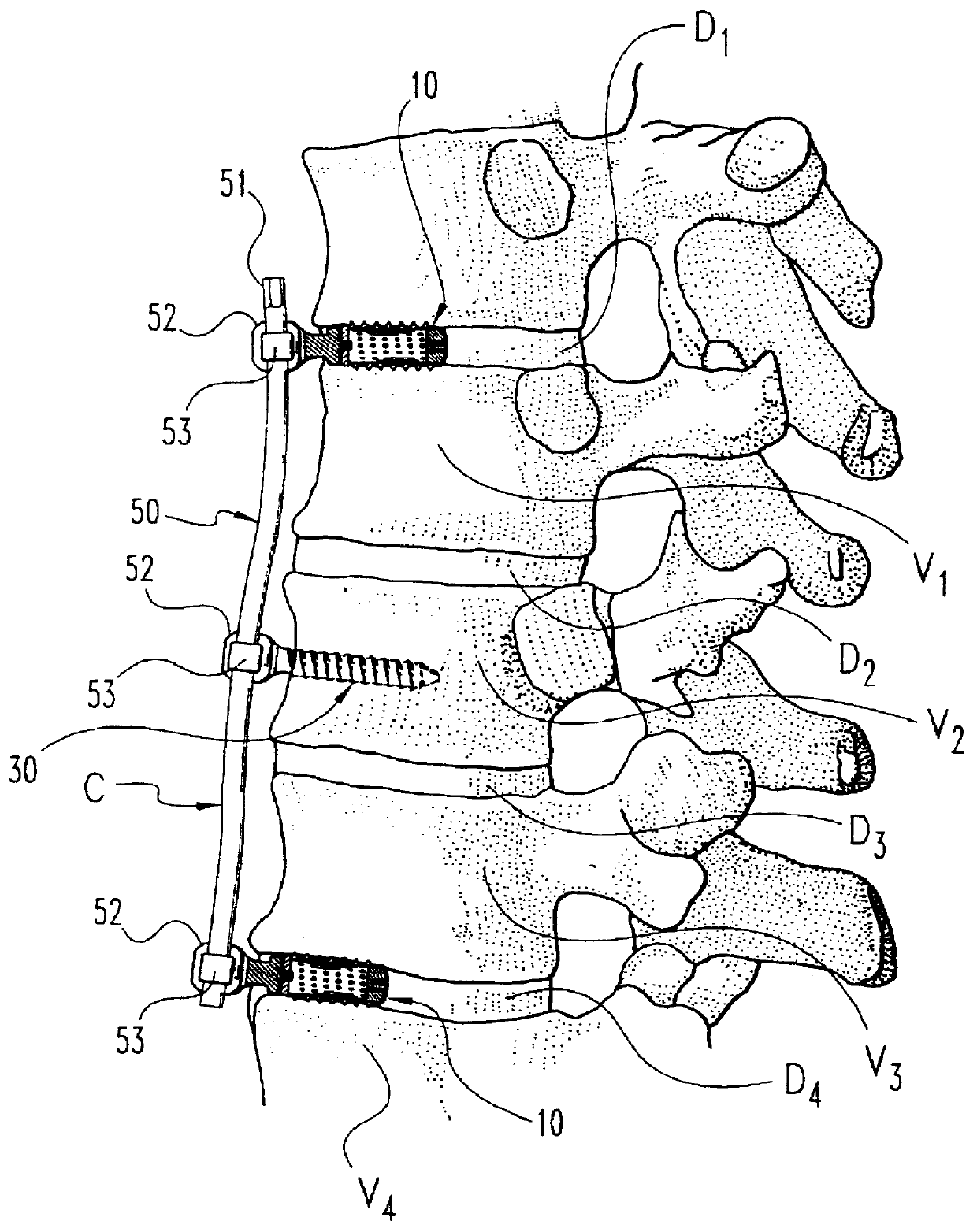 Anterior spinal instrumentation and method for implantation and revision