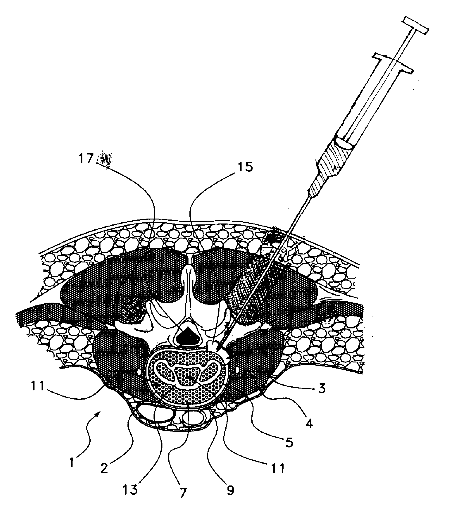 Method of using an Anti-growth matrix as a barrier for cell attachment and osteo-inductive factors