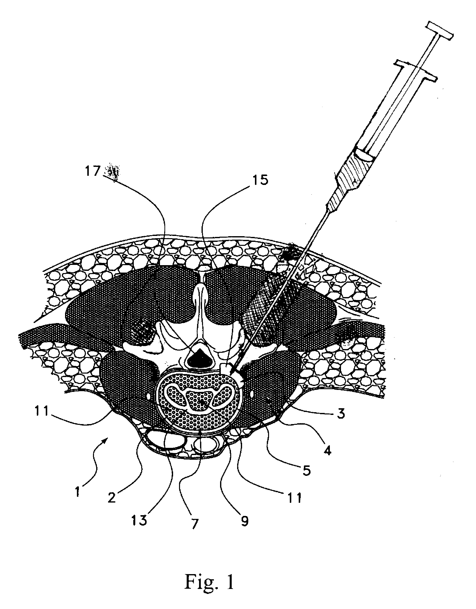 Method of using an Anti-growth matrix as a barrier for cell attachment and osteo-inductive factors