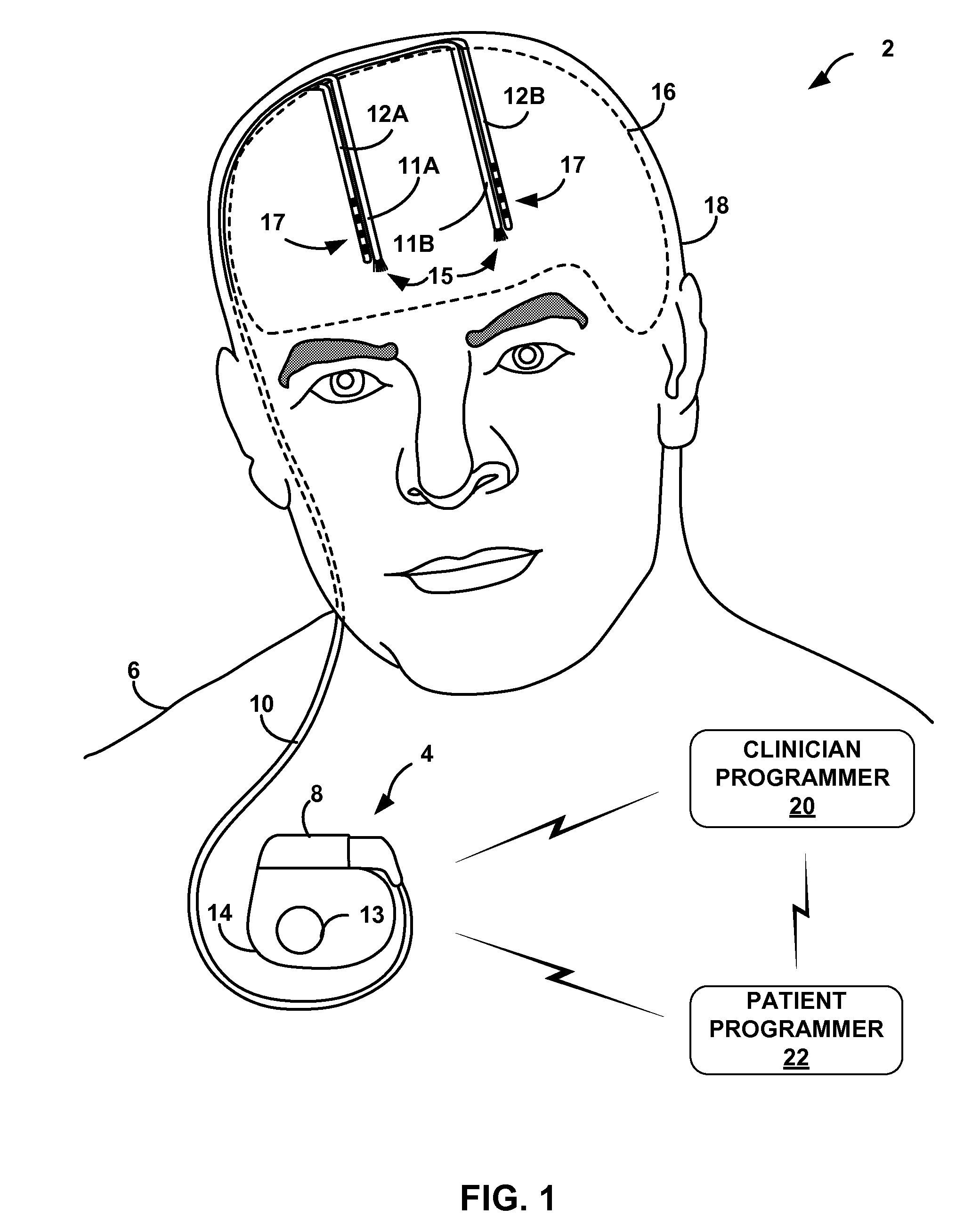 Optical stimulation therapy