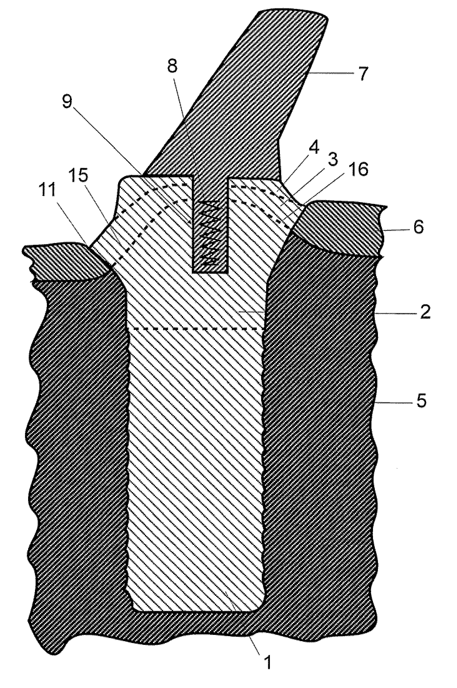 Dental Implant System